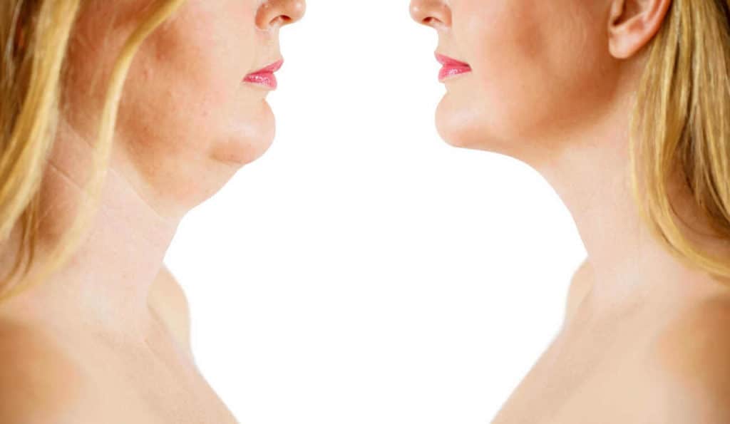 Double Chin treatment Leighton Buzzard before and after results