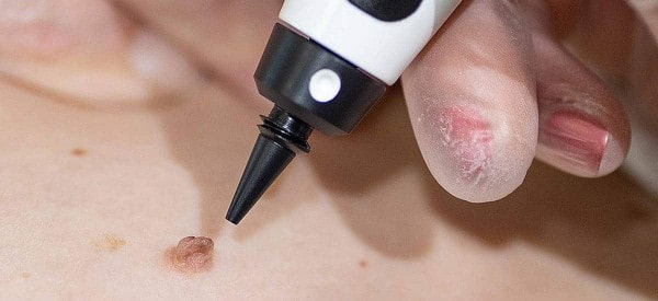 After Skin Tag Removal Leighton Buzzard