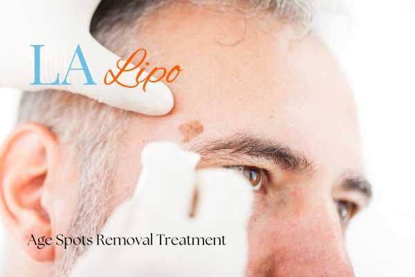 What Are the Most Effective Treatments for Age Spots Leighton Buzzard?