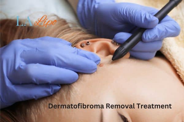 Dermatofibroma Removal Treatment Leighton Buzzard