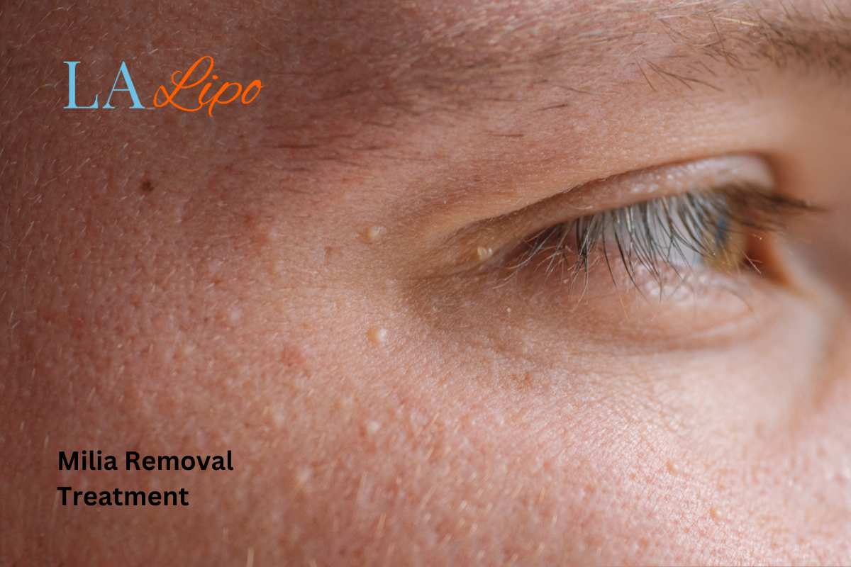 Cryopen Milia Removal: Is It the Easiest and Safest Option Leighton Buzzard?