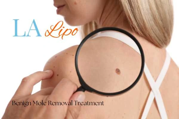 Woman having her inspection of blemish before mole removal Leighton Buzzard