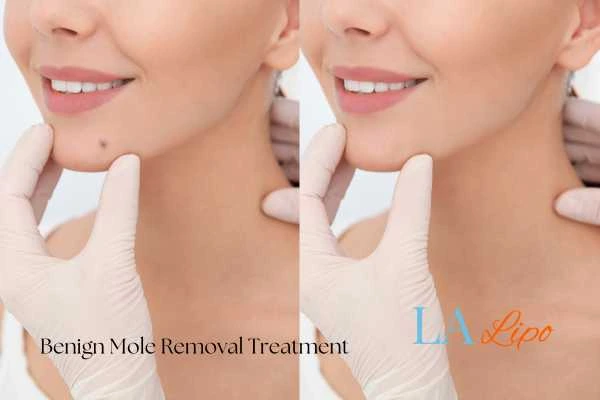 Before and after mole removal Leighton Buzzard treatment