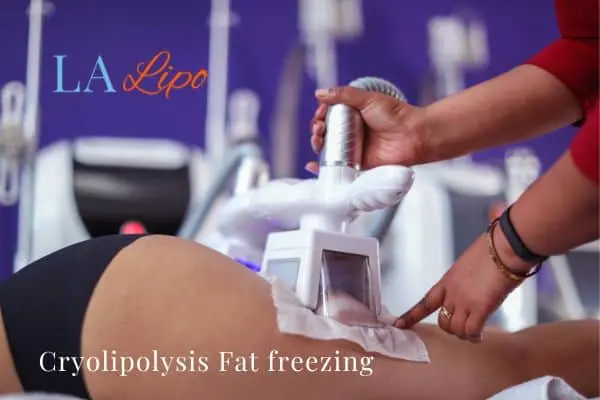 women getting fat freezing Leighton Buzzard