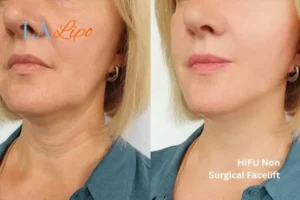 hi-fu for wrinkles Leighton Buzzard before and after results