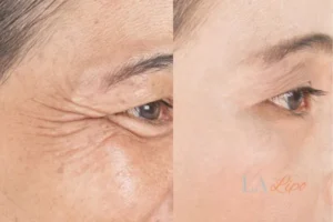 Before and after results of woman - HI-fu wrinkles reduction treatment Leighton Buzzard