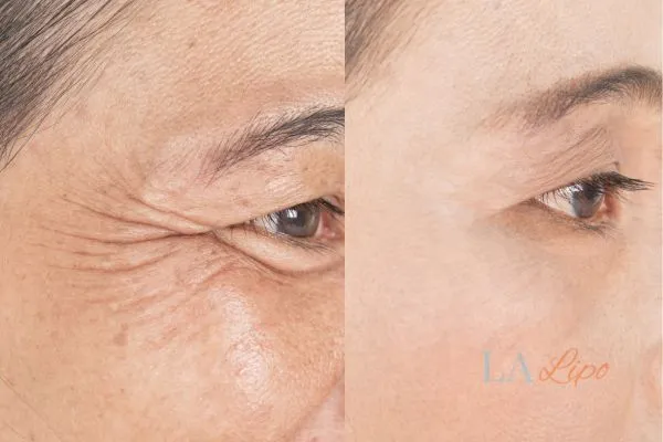 Before and after results of woman - HI-fu wrinkles reduction treatment Leighton Buzzard