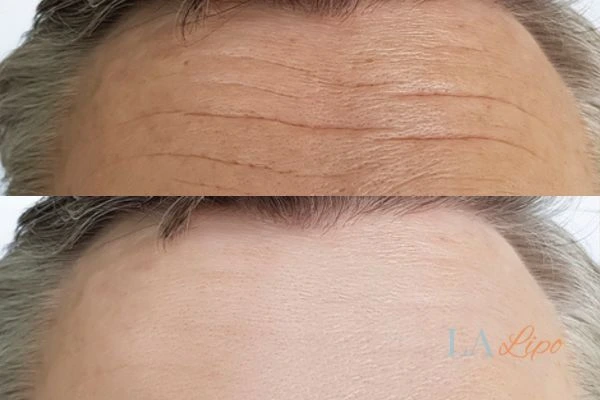 results of HIFU Leighton Buzzard on mans forehead to help reduce lines and wrinkles