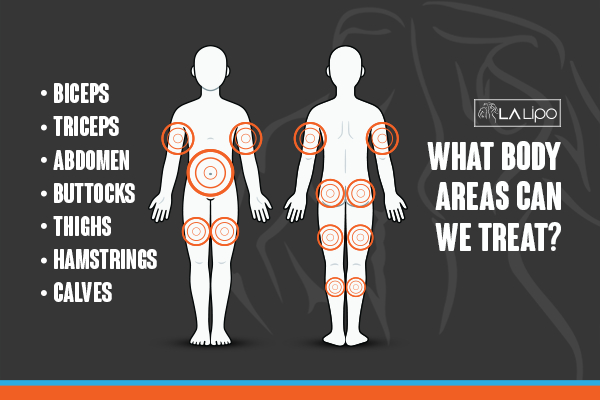 Graphic to show areas you can have LA-EMS Body Sculpting Leighton Buzzard treatment.