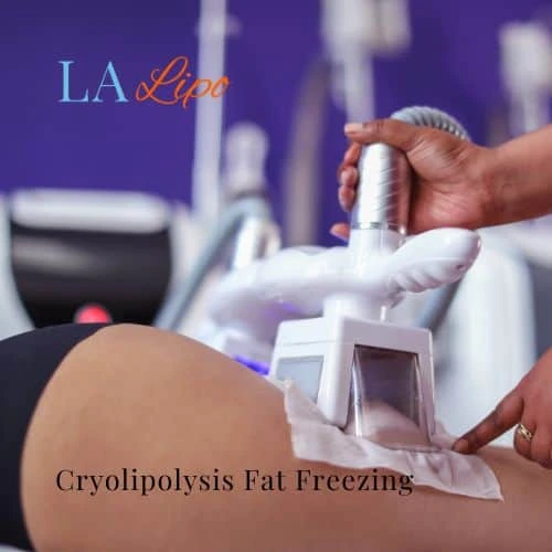 fat freezing - Cryolipolysis Leighton Buzzard