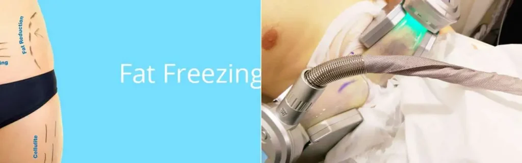 multi areas of a persons body having coolsculpting Leighton Buzzard treatment
