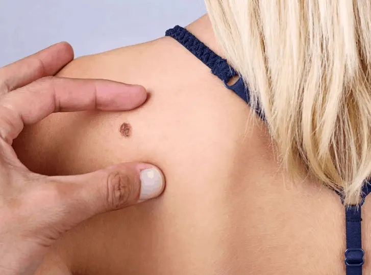 woman having mole removal Leighton Buzzard consultation before treatment.