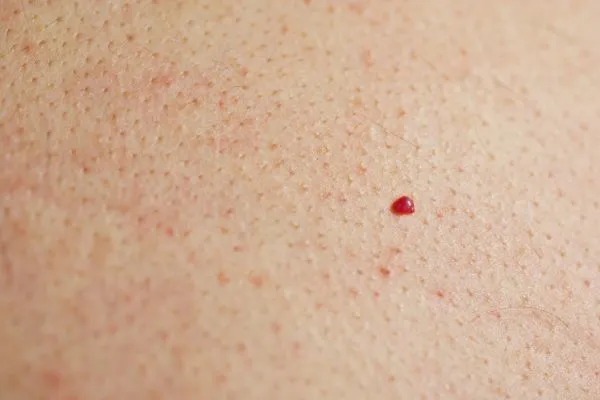 close up of a cherry angioma Leighton Buzzard