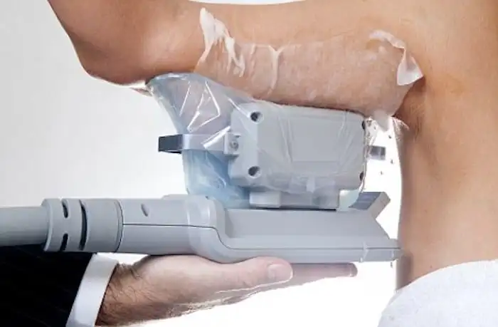 Picture of fat freezing Leighton Buzzard on the upper arms.