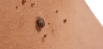 image of a skin tag Leighton Buzzard