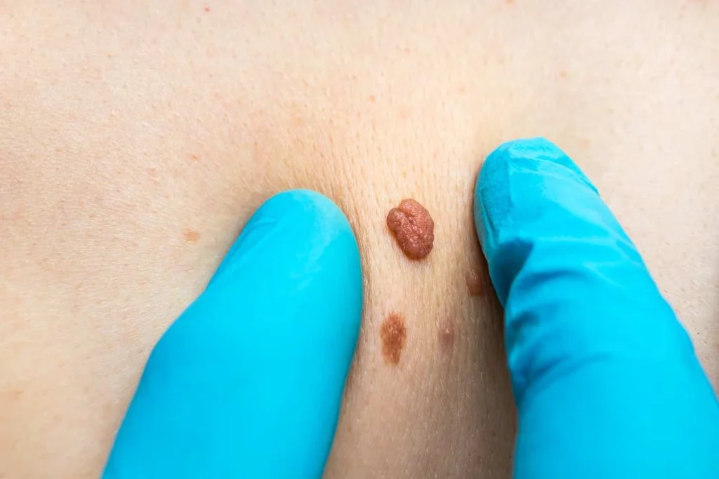 Consultant examining a skin tag Leighton Buzzard