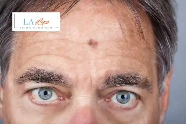 Solar Lentigo Removal Leighton Buzzard image of man with mark on his forehead