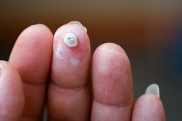 wart on person finger - cryotherapy to treat from LA LIPO Leighton Buzzard