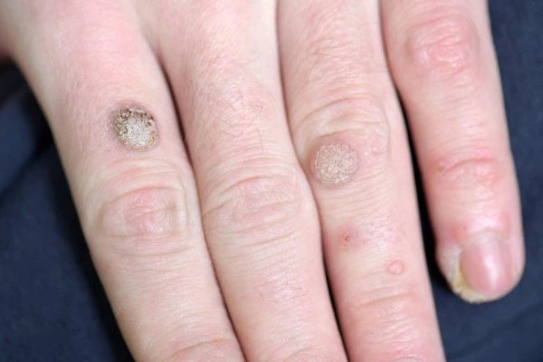 photo of warts on person hand - see wart removal Leighton Buzzard from LA LIPO