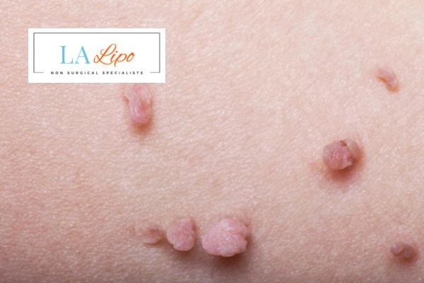 Does cryopen skin tag removal Leighton Buzzard hurt? Find out now call our team today!