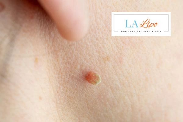 Book skin tag removal Leighton Buzzard today speak to our team now!