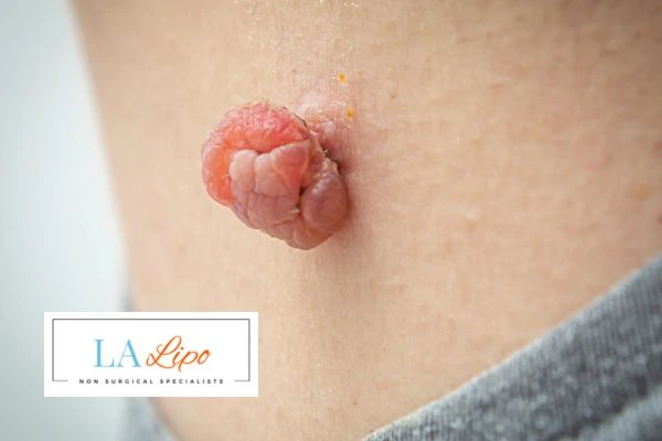 Interested in skin tag removal Leighton Buzzard? Concerned about the pain? Find out more today!