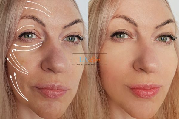 Morpheus 8 results Leighton Buzzard face lift.