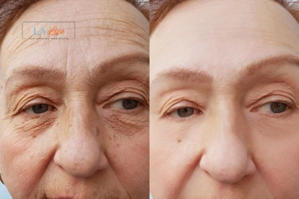 The powerful benefits of Morpheus8 Treatment Leighton Buzzard - Call Our team today!