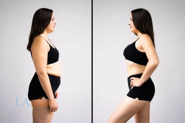 Picture of womans before and after using LA-EMS body sculpting to improve her core strength Leighton Buzzard
