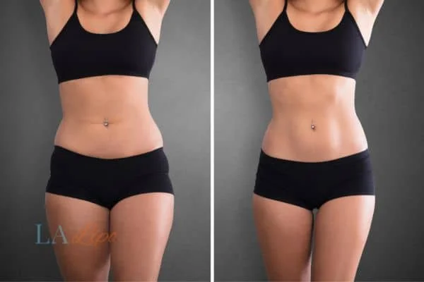 before and after results of non-surgical treatment to help a woman's body image and mental health Leighton Buzzard