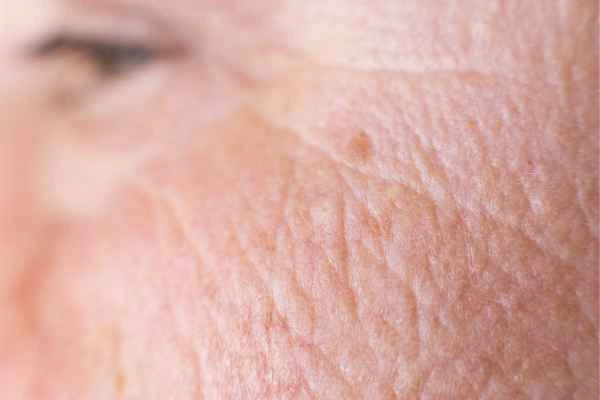 close up picture of a woman's face showing an age spot Leighton Buzzard
