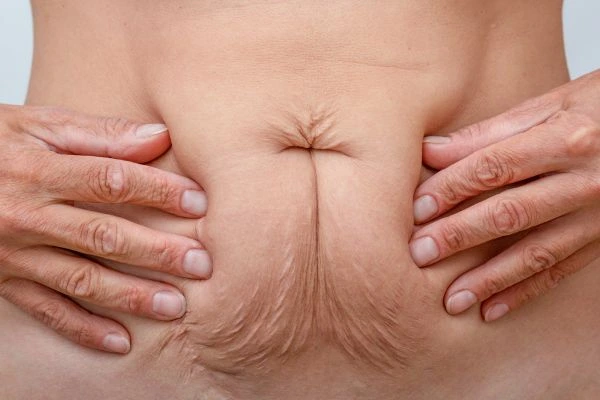 Image of a woman's stomach with loose skin - example of skin tightening Leighton Buzzard options