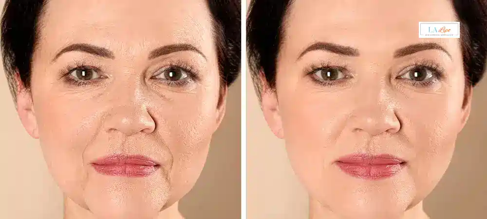 How Long Does It Take to See Results and How Long Do They Last Leighton Buzzard?