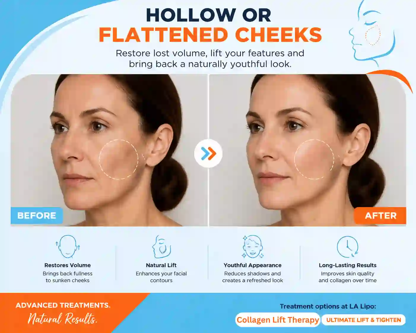 Sign #4: Hollow or Flattened Cheeks Leighton Buzzard