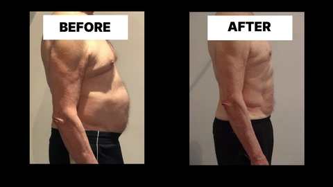 What Symptoms Can Diastasis Recti Cause in Men? Weak Core, Back Pain and Poor Posture Leighton Buzzard